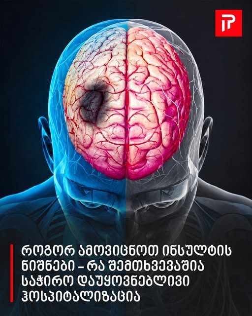 როგორ ამოვიცნოთ ინსულტის ნიშნები - რა შემთხვევაშია საჭირო დაუყოვნებლივი ჰოსპიტალიზაცია